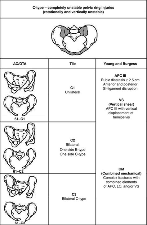 Afbeeldingsresultaten voor Pelvic Fracture Types