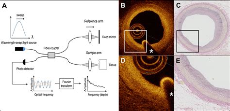 Image result for Optical Coherence Tomography Explained