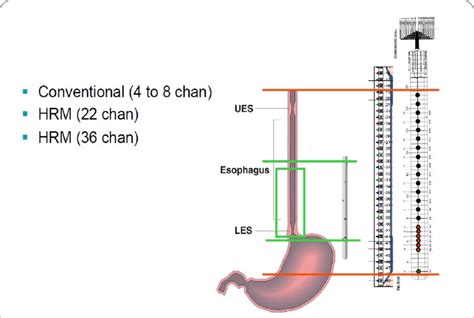 Image result for Conventional Manometry vs High Resolution Manometry