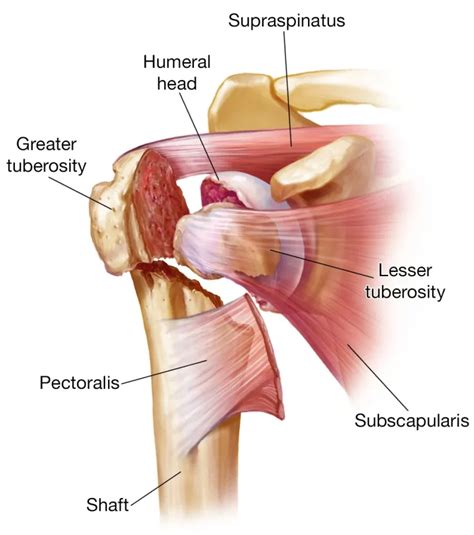 Image result for Proximal Humerus Fracture Protocol