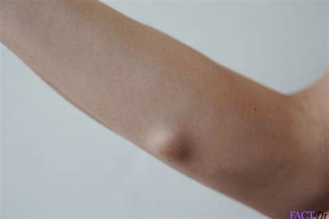 Bildergebnis für Sebaceous Cyst Arm