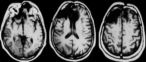 MRI Scanner Prefrontal Cortex に対する画像結果