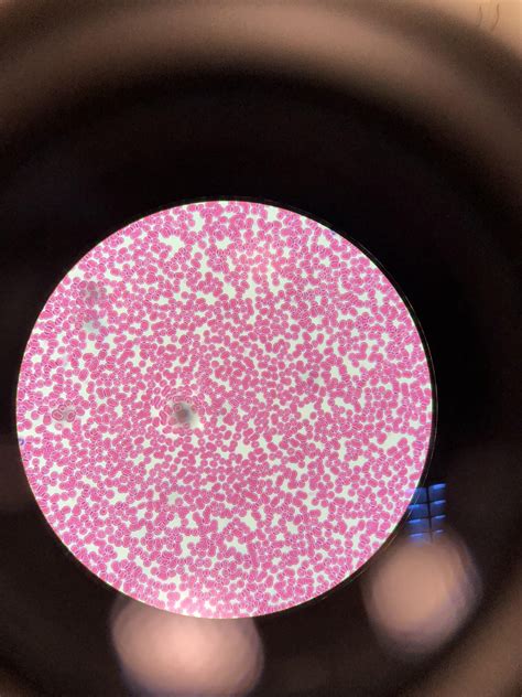 Normal Red Blood Cells Under Microscope-साठीचा प्रतिमा निकाल