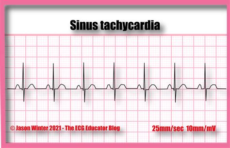Image result for Sinus Rhythm Diagram