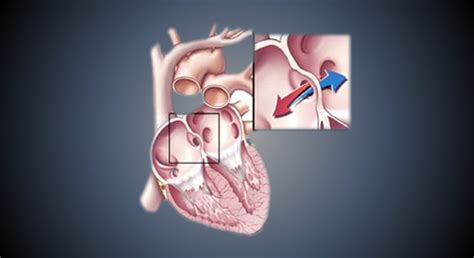 Toradh íomhá ar Ruis Atrium Septum Defect
