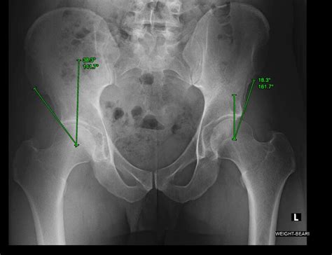 Right Hip Labrum に対する画像結果