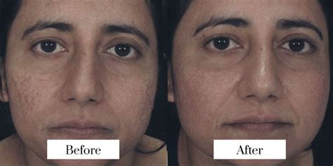 Toradh íomhá ar Before and After Needling Procedures