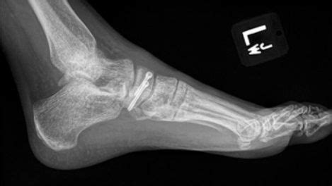 Image result for Navicular Fracture Not Healing