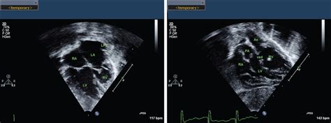 Afbeeldingsresultaten voor Corrected Transposition