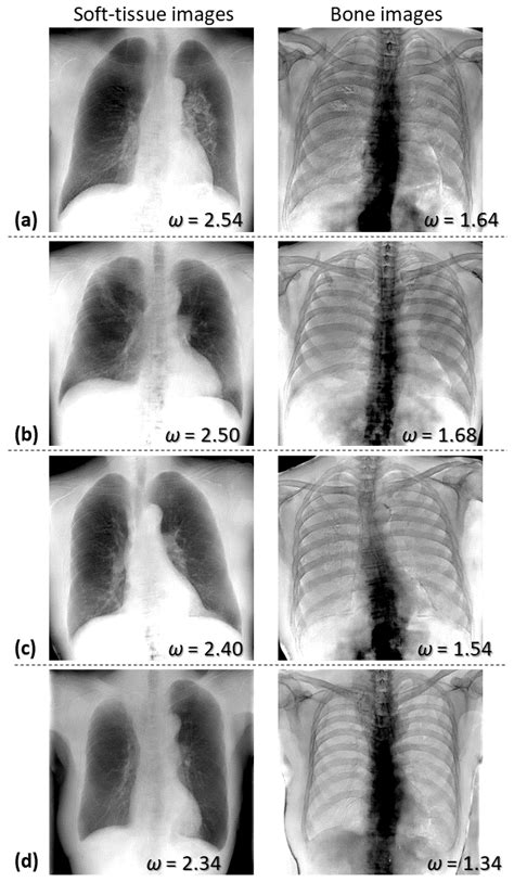 Toradh íomhá ar Dual-Energy Subtraction Algorithm