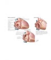 Image result for Ruis Atrium Septum Defect