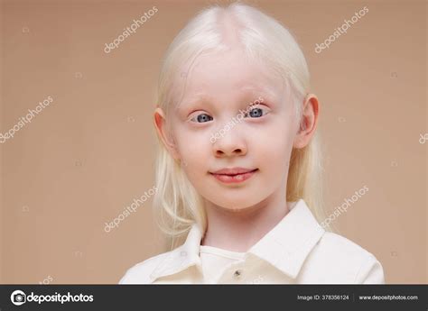 Light Blue Eyes Albinism に対する画像結果