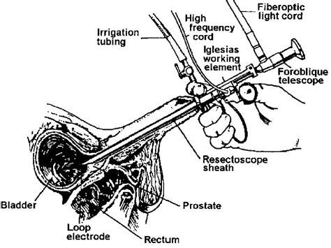 Bladder Neck Resection に対する画像結果