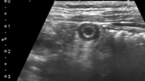 Image result for Abdominal Compression