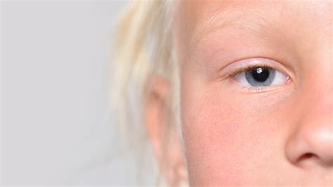 Light Blue Eyes Albinism に対する画像結果