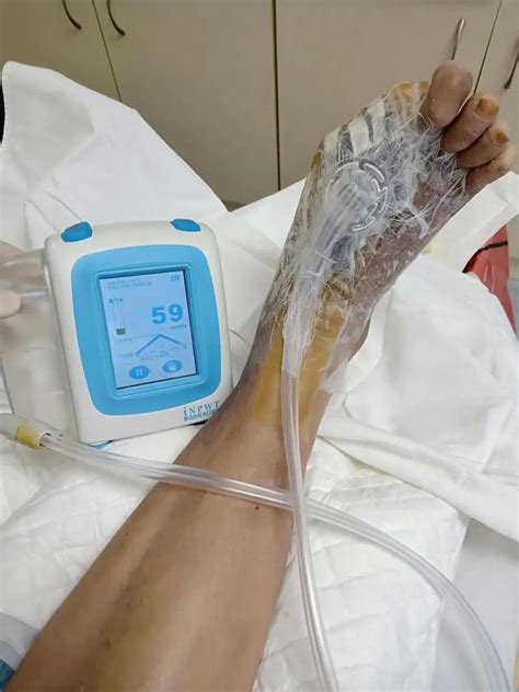 Image result for Negative Pressure Wound Vac Machine