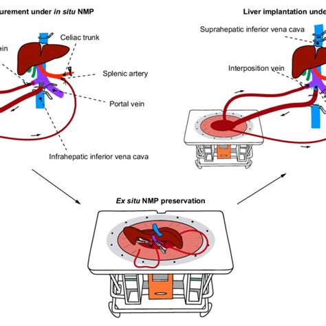 Toradh íomhá ar Liver Back Table Procurement
