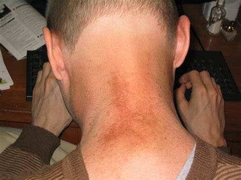 Fluroscopy Radiation Burn に対する画像結果