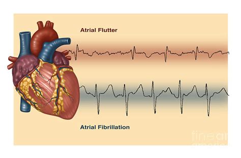 Image result for AFib Rate Control