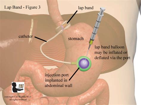 Image result for Lap Band Procedure Ultrasound