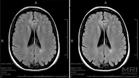 Image result for Normal Brain MRI Axial Labelled