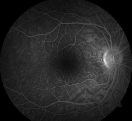 Image result for Recirculation Phase FFA