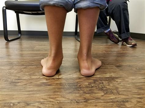 Image result for Pes Planovalgus