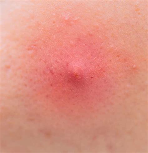 Image result for Painful Pimple Under Armpit