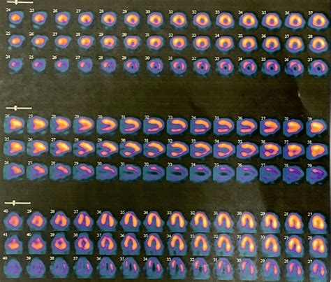 Toradh íomhá ar Stress Test Procedure