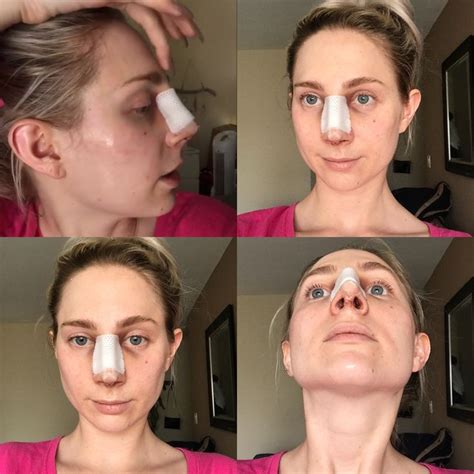 Image result for Nose Job Recovery Kit