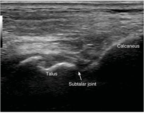 Image result for Subtalar Joint Injection vs Sinus Tarsi