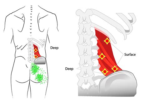 Image result for QL Muscle Spasm