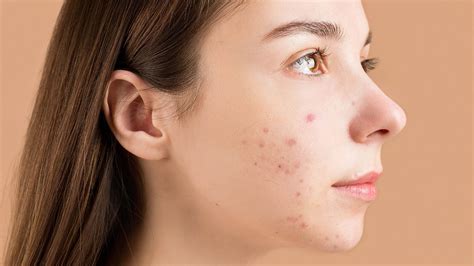 Inside Nodule Acne に対する画像結果
