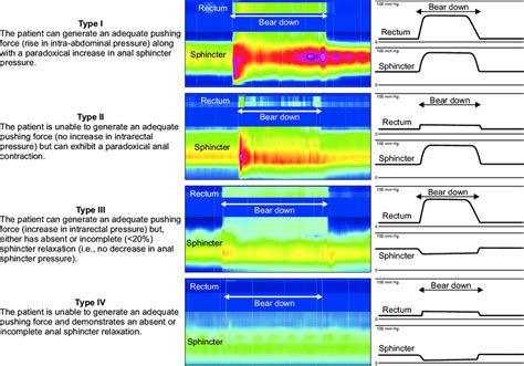 Image result for Conventional Manometry vs High Resolution Manometry