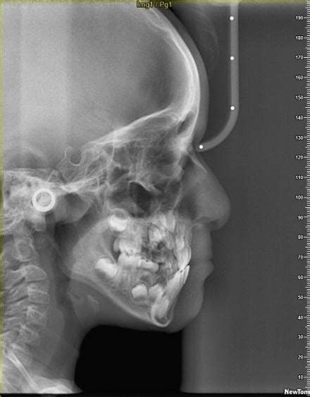 Image result for Maxillary Protraction
