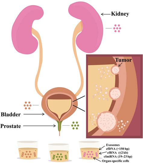 Image result for What Is an Emergent Bladder