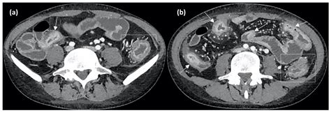 Image result for CT Enterography
