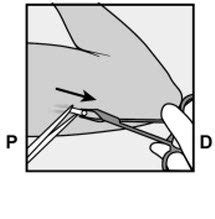 Toradh íomhá ar How to Insert Nexplanon Instructions