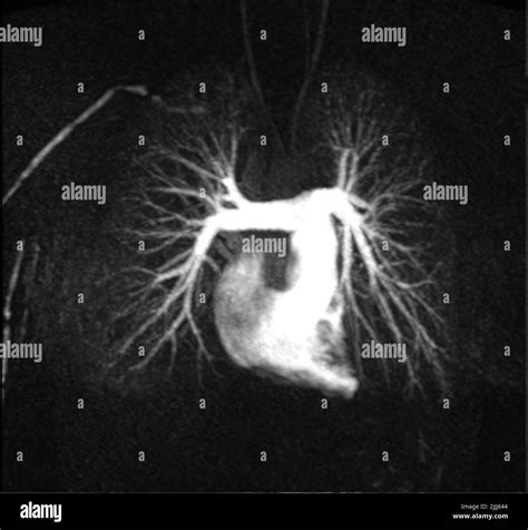 Image result for MRI Angiogram