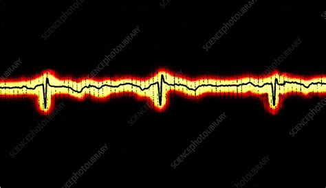 Afbeeldingsresultaten voor Normal EcG