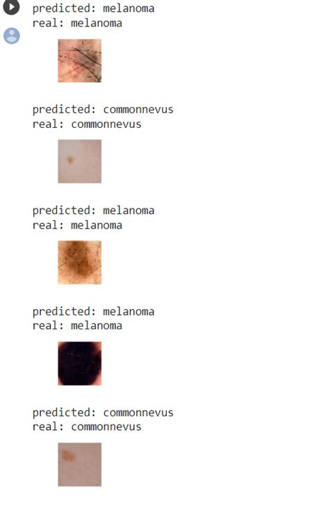 Image result for Skin Cancer Detection Using CNN