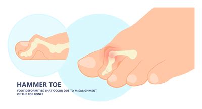 Image result for Hammer Toe Problems