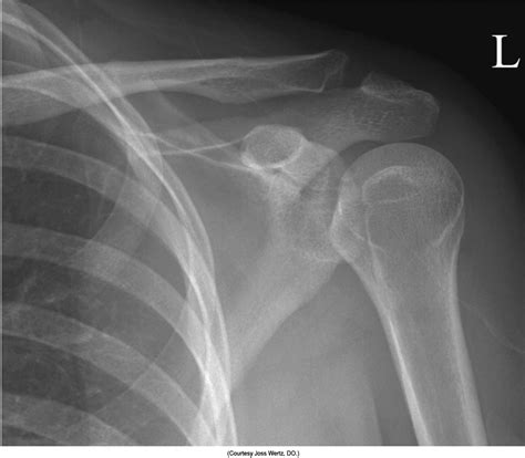 Image result for What Is Shoulder Internal Rotation