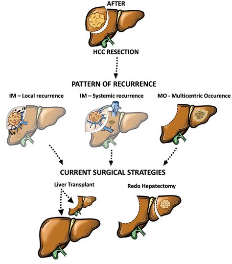 Toradh íomhá ar Liver Tumor Recurrence