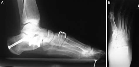 Calcaneonavicular Coalition Resection With Pes Planovalgus ...