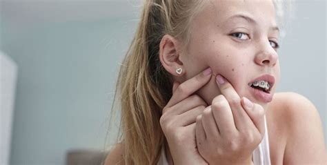 Image result for Pimple Pop Blast