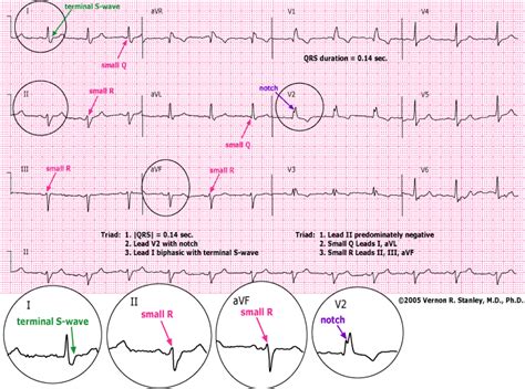 Afbeeldingsresultaten voor ECG Study