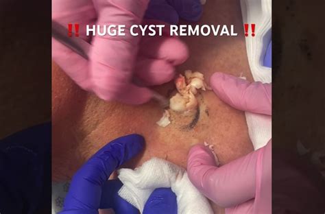 Exploding Cyst Sac に対する画像結果