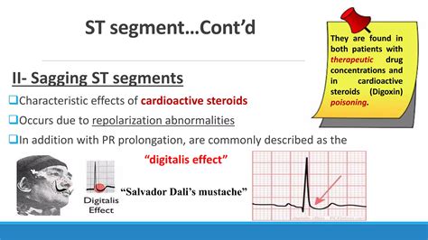 Image result for ECG Step by Step Guide
