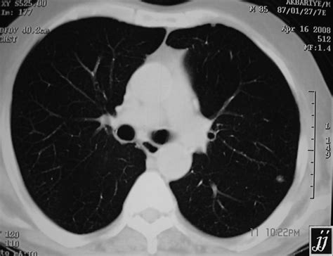 Lung Metastasis Prostate Cancer に対する画像結果